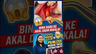 Bina Dard Ke Akal Dadh Kaise Nikala , Dekho Patient Par |Painless Wisdom Tooth Extraction #trending