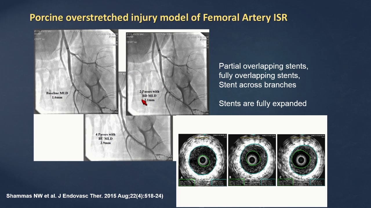 Атерэктомия с использованием струйной струи – почему, когда и как? - Николас Шаммас, доктор медицины