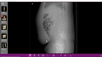 O que provoca trombose no intestino?