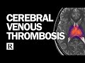 Diagnosis and management of cerebral venous thrombosis
