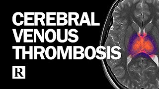 Diagnosis and Management of Cerebral Venous Thrombosis by The Neurophile (by Rutgers RWJMS Neurology) 71,409 views 3 years ago 43 minutes