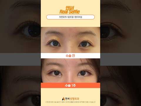자연유착쌍꺼풀+앞트임+원더트임 1주/2주