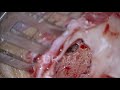 COCHLEAR IMPLANTATION IN MUMBAI - DR.MEENESH JUVEKAR