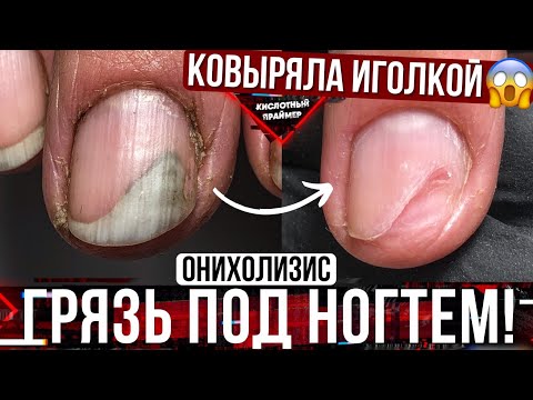 ⚡ДОКОВЫРЯЛАСЬ ИГОЛКОЙ ДО ОНИХОЛИЗИСА!? Зачистка онихолизис ногтей на руках?