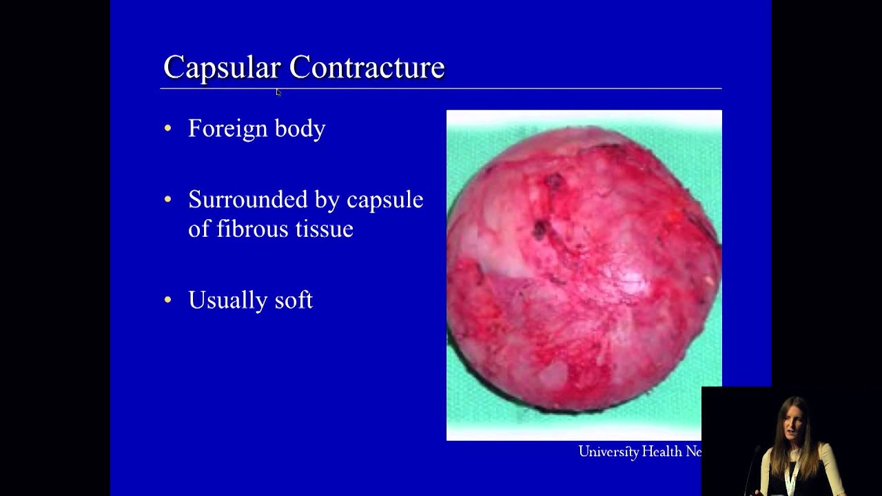 breast augmentation after radiation breast augmentation after radiation