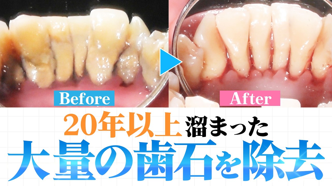 【歯石除去】20年以上溜まった大量の歯石を除去✨治療できなかった理由とは…?