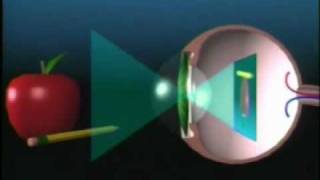 Washington DC Laser Vision Correction & Nearsightedness