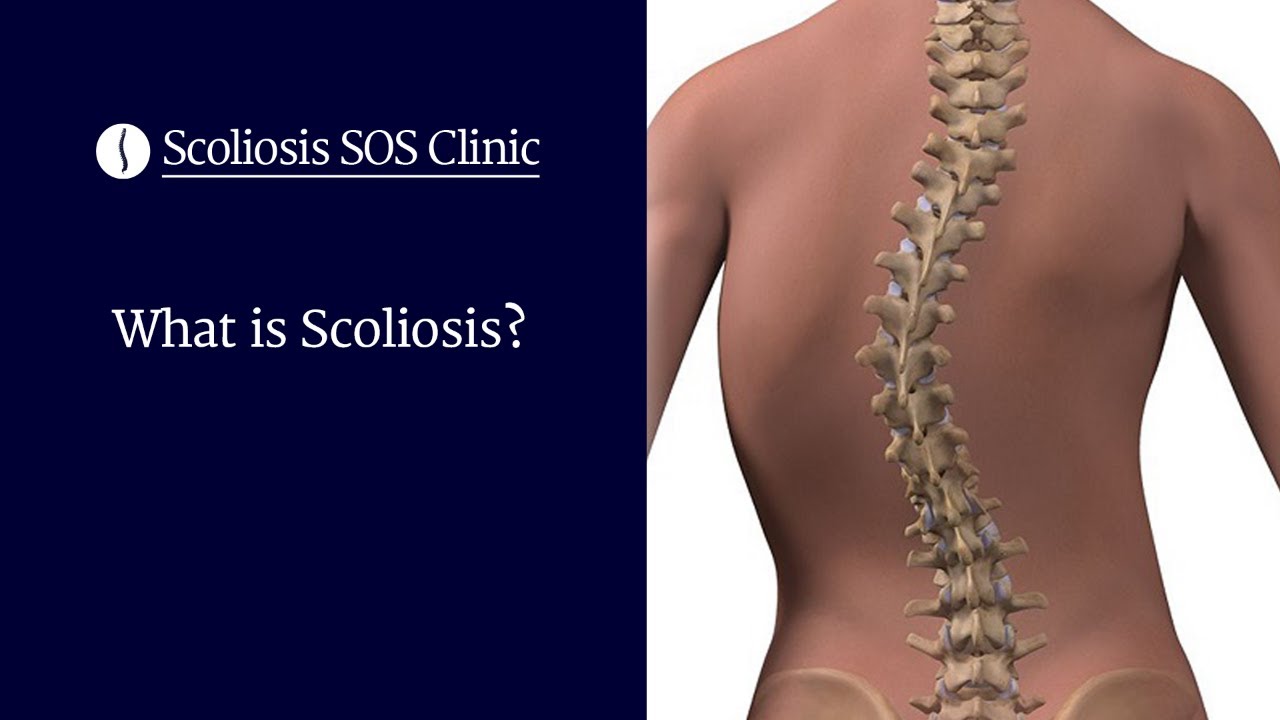 What Is Scoliosis Scoliosis Sos