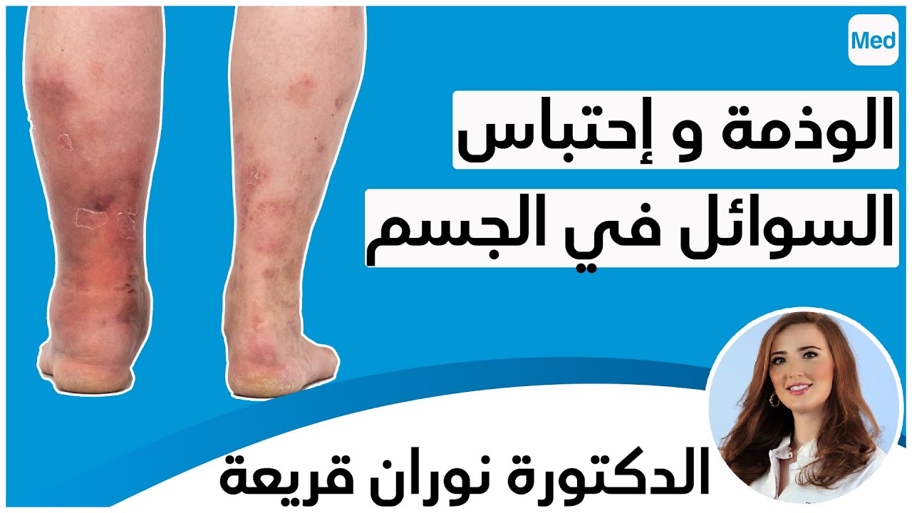 الوذمة و إحتباس السوائل في الجسم | الدكتورة نوران قريعة