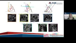 Guidelines and Recommendations for Performance of the Fetal Echocardiogram: An Update from ASE