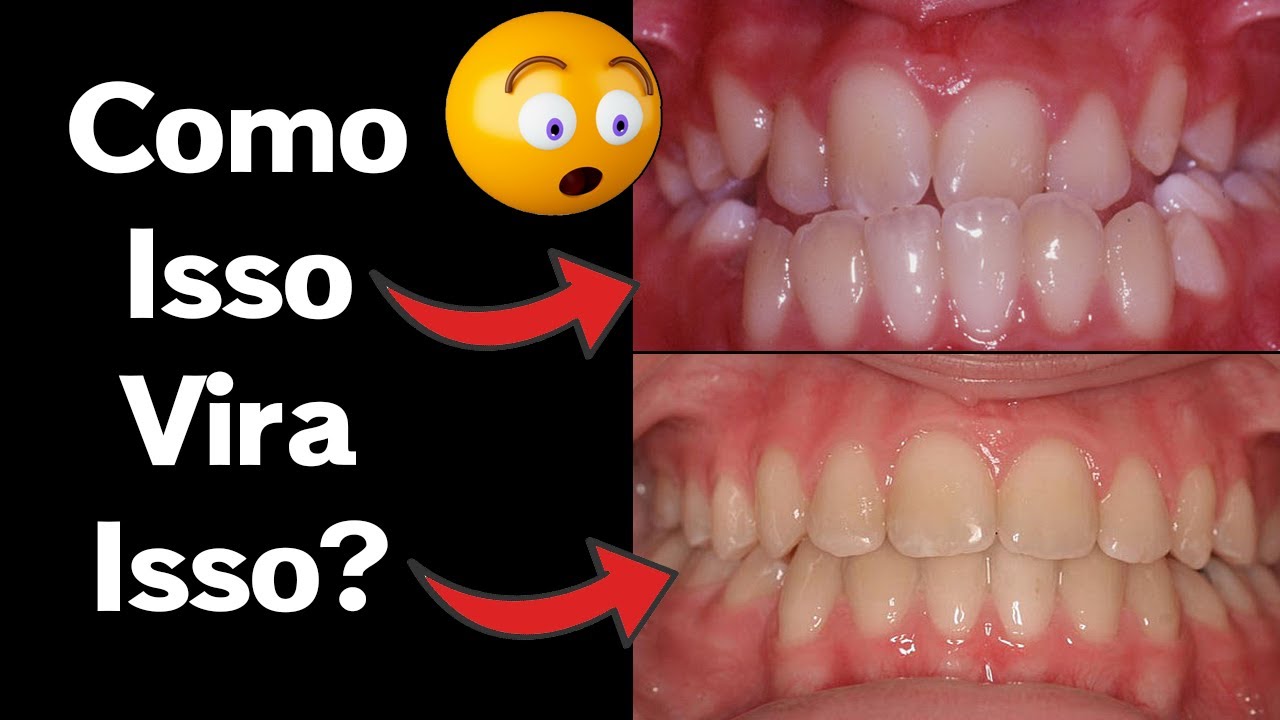 aparelho-nos-dentes-explicado-descubra-como-o-aparelho-dent-rio