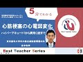 日本循環器学会　5分でわかる循環器Best Teacher Series　心筋梗塞の心電図変化　ハイパーアキュートTから異常Q波まで　東京歯科大学市川総合病院循環器内科　宮本　和享
