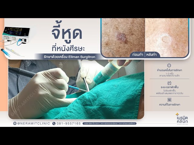 รีวิวจี้หูด ขี้แมลงวัน EP.278/หูดที่หนังศรีษะ เกิดขึ้นได้อย่างไร? @หมอปุ๊ NeramitClinic