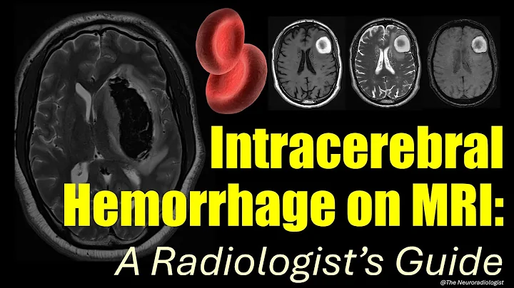 Intracerebral Hemorrhage on MRI: a step-by-step guide for radiologists.