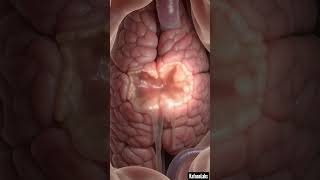 Black Stool? Think Gastric Ulcer