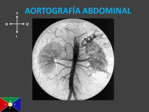 Estudio radiográfico contrastado de las arterias del abdomen