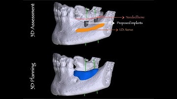 CAD CAM Allograft Vertical Bone Augmentation