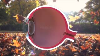 Ravi Goel MD: Glaukos iStent inject Patient Video (Glaucoma and Cataract Surgery) Istent Glaucoma Surgery L Jay Katz Md