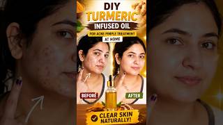 Pimple Acne removal on face at home| DIY face mask- Active Acne. #shorts #skincare #acne #pimple