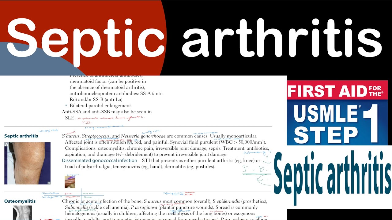 Septic arthritis in Hindi/Urdu by first aid for USMLE step 1 - YouTube