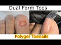 POLYGEL TOENAILS W/ Dual Forms  Ugly Toes w/ Amazing Transformation !