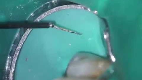 Broken file removal with zumax kit by Assoc Prof Dr Talal Al-Nahlawiد. طلال النحلاوي