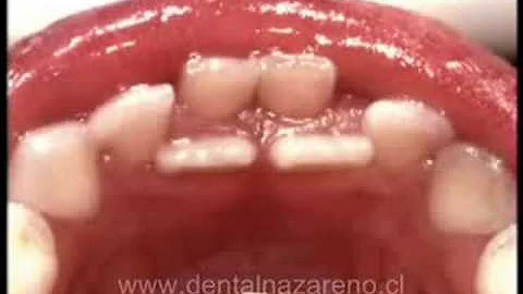 ¿A qué edad salen los dientes dobles?