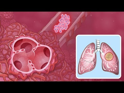 Vídeo: Cáncer De Pulmón De Células Grandes: Síntomas Y Pronóstico. Cómo Tratar El Cáncer De Pulmón De Células Grandes