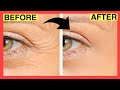 Eye Massage for Wrinkles | Wrinkles Removal at Home