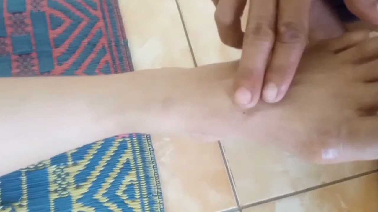 benjolan hilang seketika