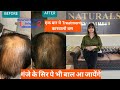 100% gauranteed natural ingredients एक बार ये Treatment करवालो बस,तो गंजे के सिर पे भी बाल आ जाएंगे