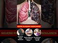 Severe Pulmonary TB: 3 Dangerous Symptoms You Must Know