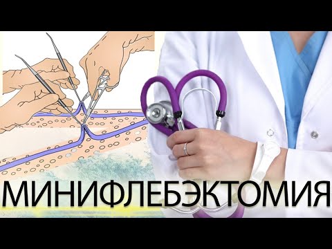 Кому нужна МИНИФЛЕБЭКТОМИЯ?