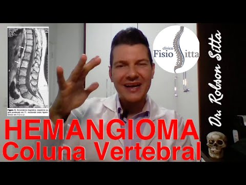 Vídeo: Hemangioma Da Coluna - Tratamento, Hemangioma Das Regiões Cervical E Torácica