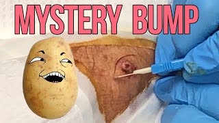 Potato Pat's Mystery Bump Removal - Possible Keratoacanthoma