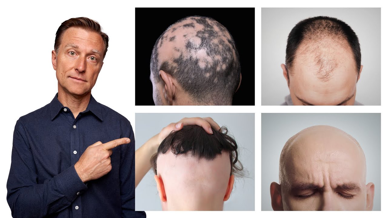 The 11 Types of Alopecia (AND HOW TO FIX IT) - Dr. Berg - YouTube