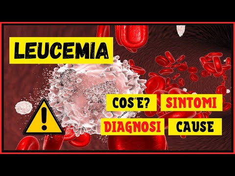 Leucemia: Cos&rsquo;è? Come si sviluppa? Come viene diagnosticata? Quali sono i sintomi e le cause?