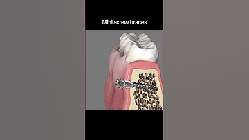 Cận cảnh cắm minivis khi niềng răng #youtubeshort #dental #viral #dentist #bedental