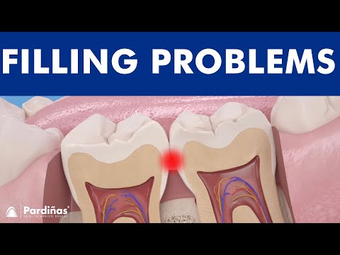 Video: Kaip žinoti, kada dantų plombavimas nereikalingas: 8 žingsniai