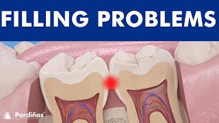Problems with tooth filling - Overflowed filling ©