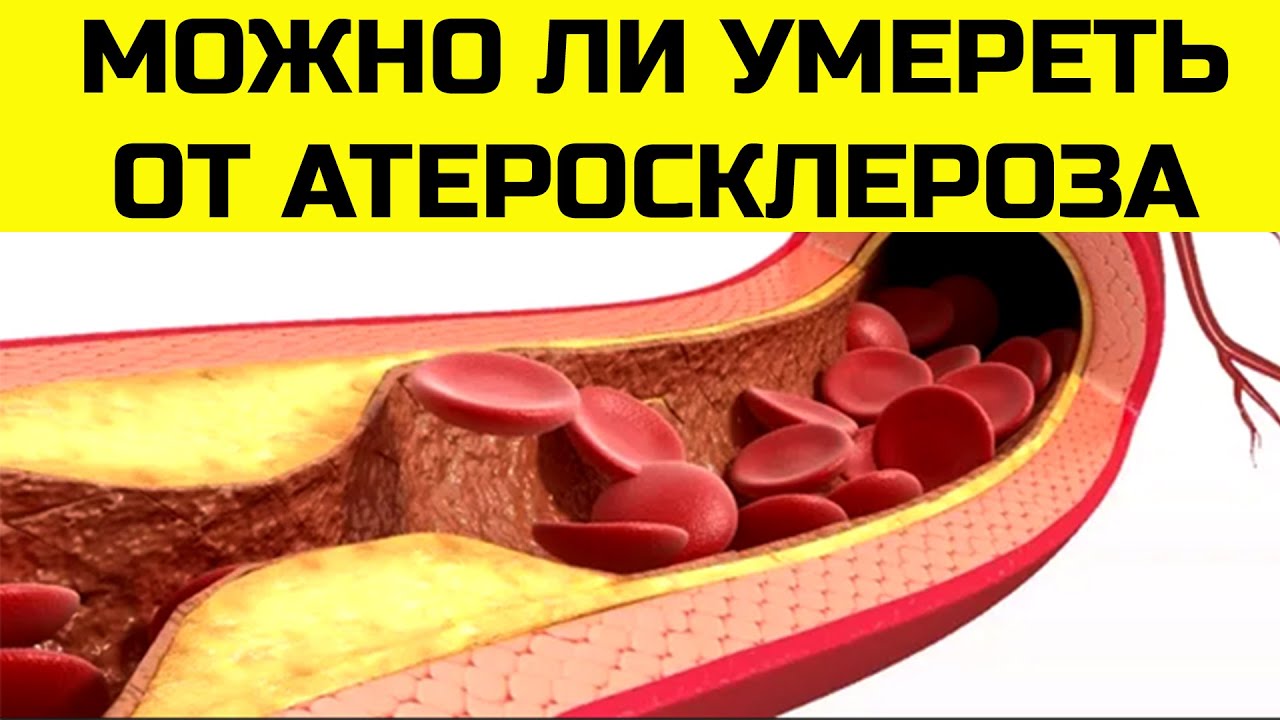 Лечим атеросклероз сосудов ног. Как лечить атеросклероз сосудов. атеросклероз нижних конечностей препараты для лечения. как проявляется атеросклероз нижних конечностей. возможно ли очистить сосуды от бляшек холестериновых.