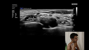 Suprascapular Nerve Sonotracking - Proximal approach
