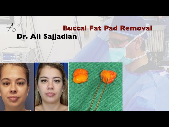 Have You Always Wanted a Chiseled Face? Learn About Buccal Fat Removal -  Ali Sajjadian, MD