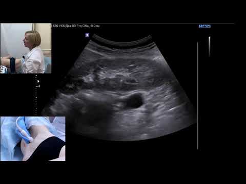 Видео: Интерлобуларна артерия в бъбрека?