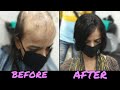 LADIES NON SURGICAL HAIR TRANSPLANT||CONTACT-(9711944387)||PRINCE KING HAIR!