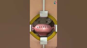 Myomectomy (Fibroid Removal) ↪ 3D Medical Animation #Myomectomy #Fibroid #Shorts #Abdominal