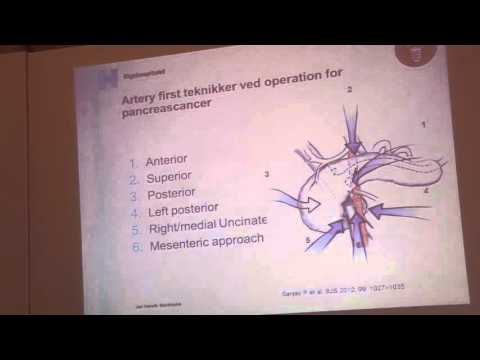 Pancreas Cancer Dag 3: Kirurgiske perspektiver: Overlæge Jan Henrik Storkholm