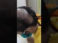 Alopesia Areta 100% Result Hai. 8867239831