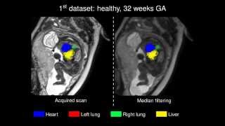 MICCAI 2015 - Automated Localisation of the Heart, Lungs and Liver in Fetal MRI
