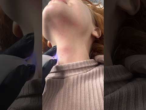 Удаление новообразований :без боли и быстро #косметологростов #фулфейс #губы #идеальнаякожа